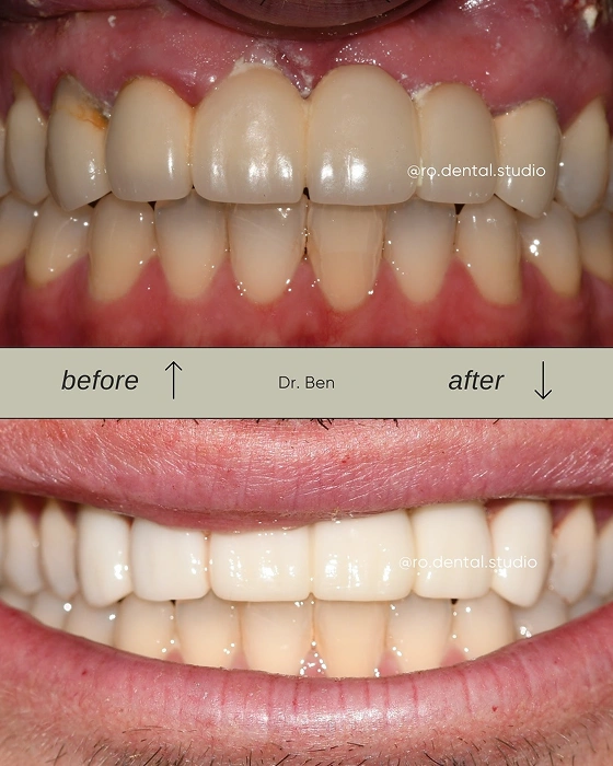 Bite Correction Before After