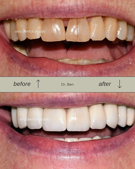 Broken Front teeth repair Before After