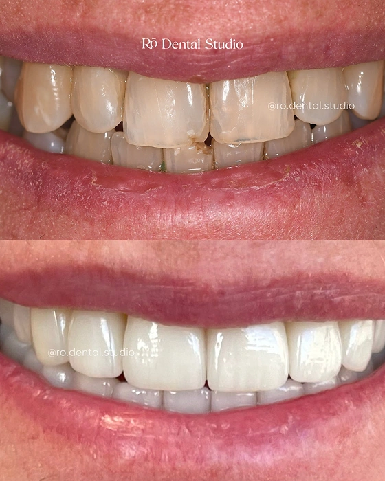 Before-and-after smile transformation by Dr. Ben, improving balance, function, and aesthetics with a natural-looking cosmetic dentistry result tailored to the patient's smile.
