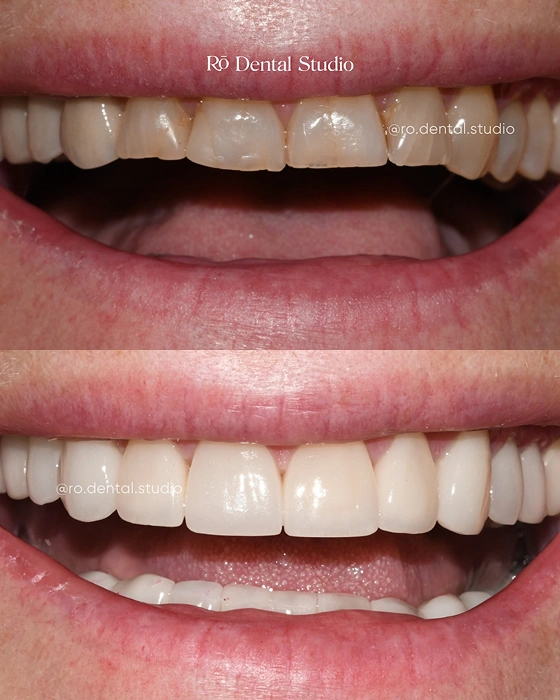 Before-and-after cosmetic dentistry transformation restoring worn tooth edges, refining tooth shape, and creating a fuller, natural-looking smile with a personalized smile design.