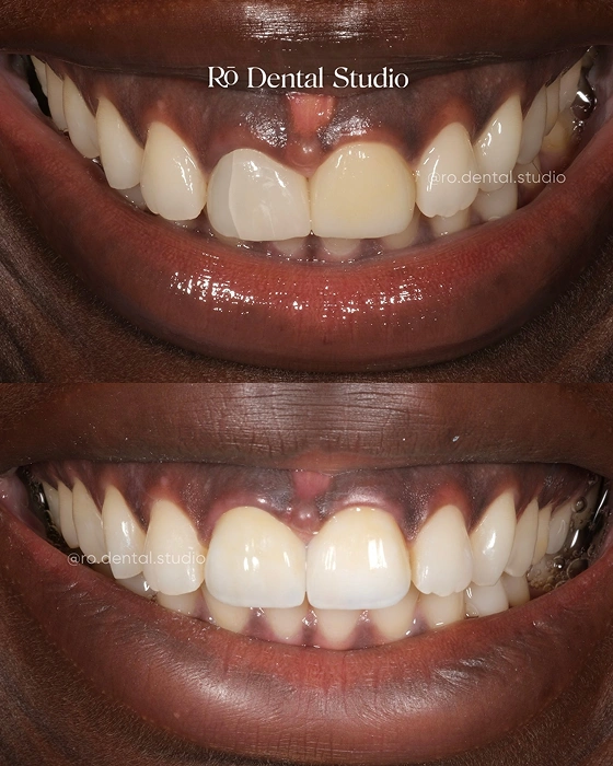 Before-and-after smile transformation showing a natural-looking cosmetic dentistry result with balanced tooth shape, color, and symmetry customized to complement the patient's facial features.