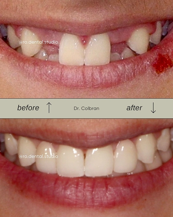 Cosmetic Bonding Gap Repair Before After