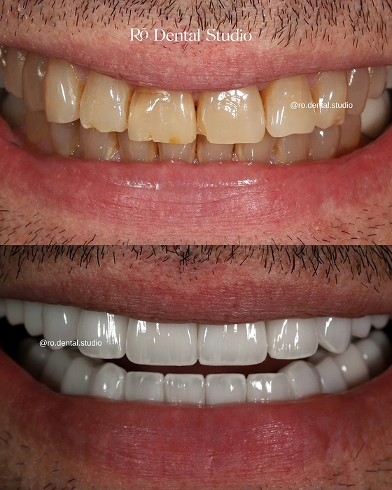 Patient smiling with a bright, healthy-looking smile after cosmetic dental treatment, showcasing natural-looking results from a personalized smile makeover consultation with Dr. Ben.
