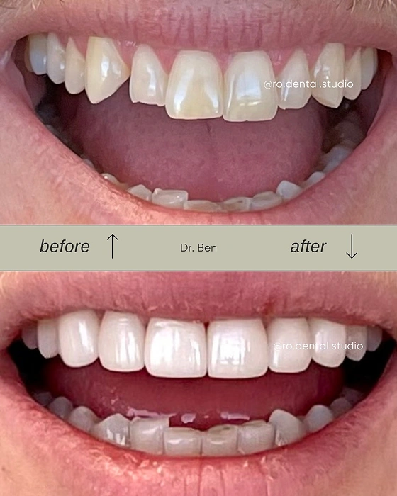 Cosmetic Dentistry Veneers Case