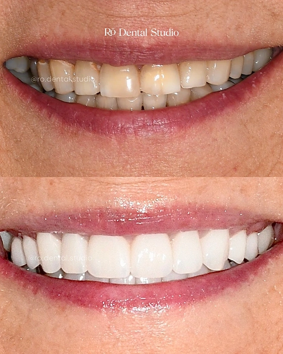 Before-and-after smile transformation by Dr. Ben, combining advanced dental technology and personalized smile design to create a natural-looking, confident smile.
