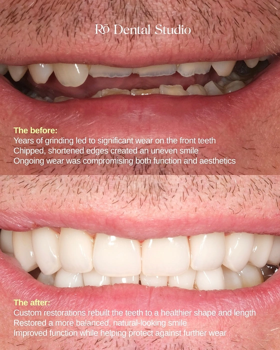 Dr. Ben's smile transformation showing before-and-after results of cosmetic dental treatment, highlighting a natural-looking, enhanced smile achieved through a personalized treatment plan.