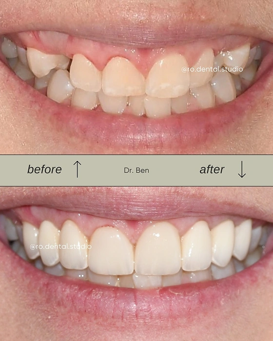 Crooked Teeth Before and After Treatment