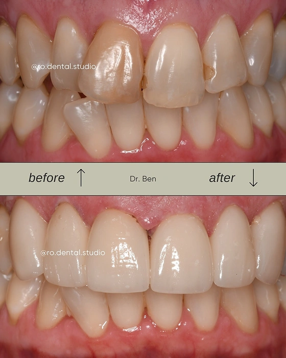 Dental Alignment Before and After