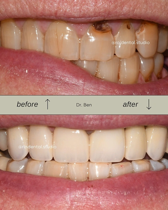 Dental Bonding Before and After Teeth