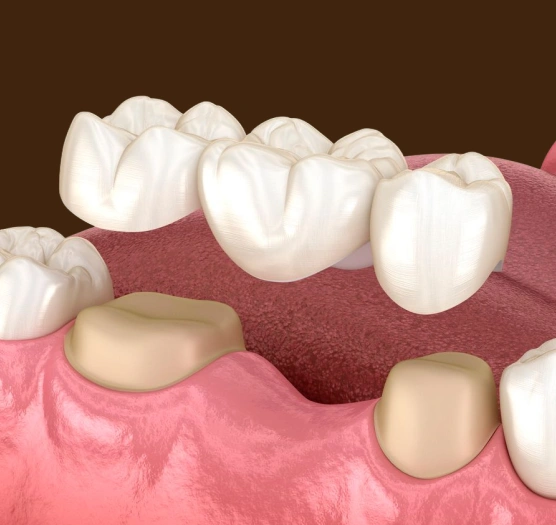 Dental bridge illustration at Ro Dental Group in Calgary, Alberta, showing a fixed restoration used to replace a missing tooth and restore a complete smile.