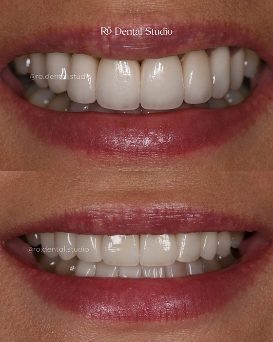 Before-and-after subtle smile transformation by Dr. Ben, enhancing tooth shape, color, and symmetry for a natural-looking, refreshed smile.