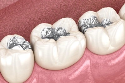 Ceramic dental fillings restoring multiple teeth with durable, natural-looking restorations at Ro Dental Group in Calgary, AB.