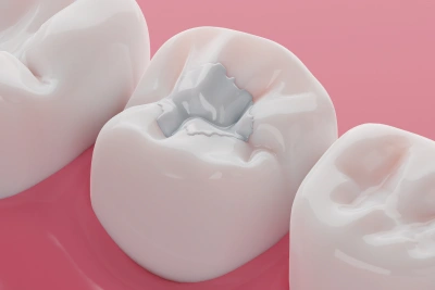 Composite tooth filling restoring a cavity with a natural-looking, tooth-coloured resin at Ro Dental Group in Calgary, AB.