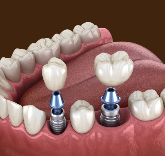 Illustration of a dental implant replacing a missing tooth with a natural-looking implant crown at Ro Dental Group in Calgary, AB.