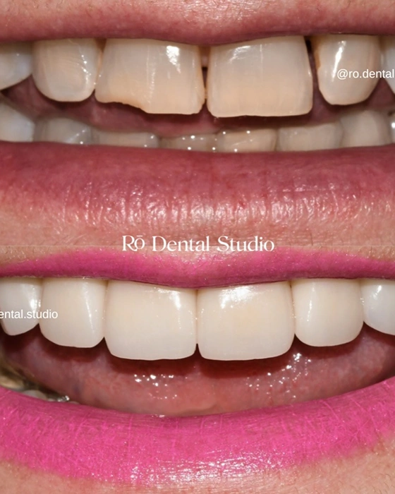 Before-and-after smile transformation showcasing improved tooth appearance, function, and confidence with a natural-looking cosmetic dentistry result tailored to the patient's smile