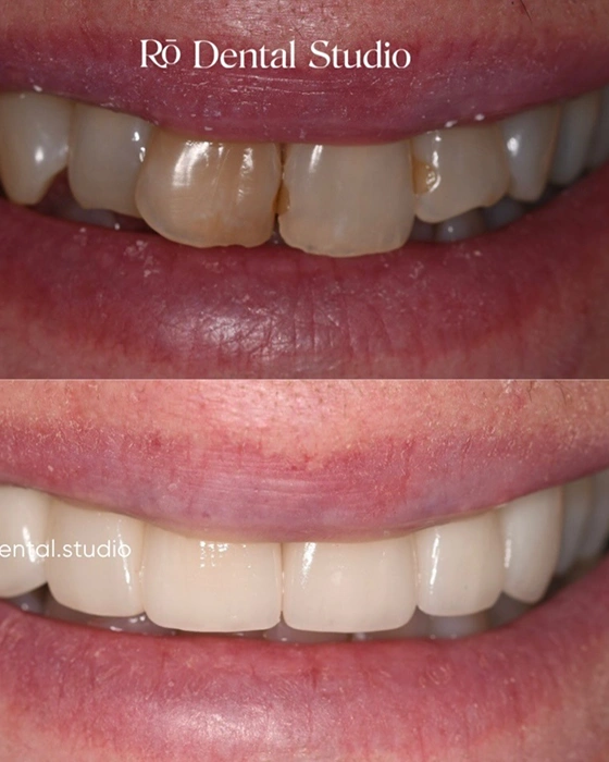 "Before-and-after teeth transformation showing a brighter, natural-looking smile with custom veneers, designed through a personalized smile planning process and mock-up preview.