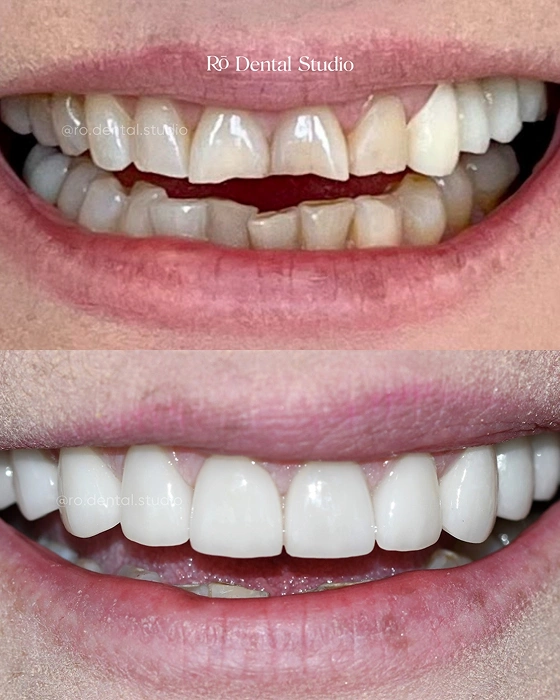 Before-and-after smile restoration using a combination of crowns, bridges, and veneers to create a healthy, natural-looking, fully restored smile.