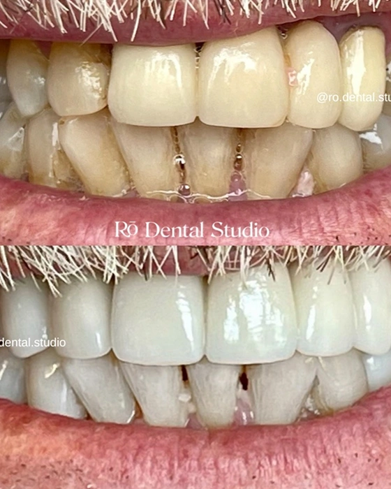 Before-and-after smile makeover replacing worn or outdated dental restorations with a brighter, natural-looking smile through personalized cosmetic dentistry.