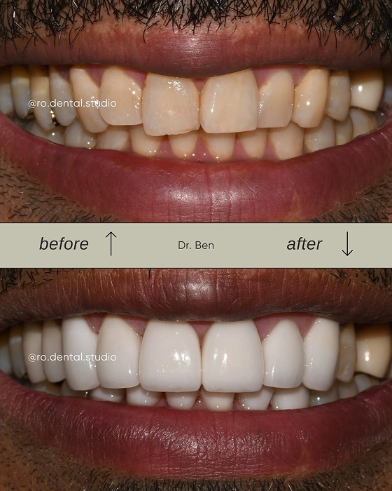 Full Mouth Rehabilitation Before and After