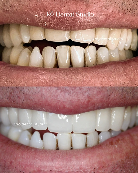 Full Smile Restoration Before and After