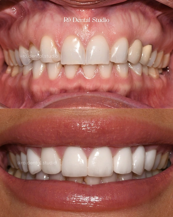 Before-and-after smile transformation showcasing a beautifully enhanced, natural-looking smile achieved through personalized cosmetic dental treatment with Dr. Ben.