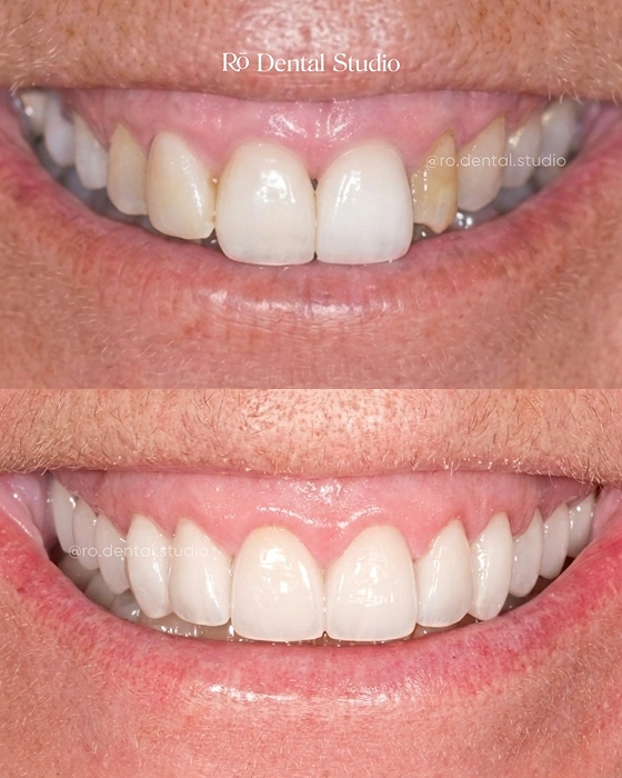 Before-and-after veneer transformation revealing a brighter, natural-looking smile, helping the patient smile confidently after years of hiding their teeth.