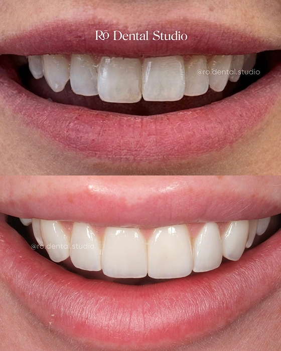 Before-and-after no-prep veneer treatment showing a brighter, straighter, natural-looking smile achieved with minimally invasive cosmetic dentistry.