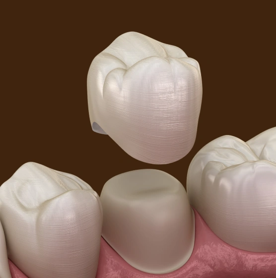 Illustration of a custom ceramic dental crown being placed over a prepared tooth at Ro Dental Group in Calgary, AB.
