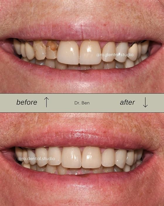 Smile Makeover Before and After