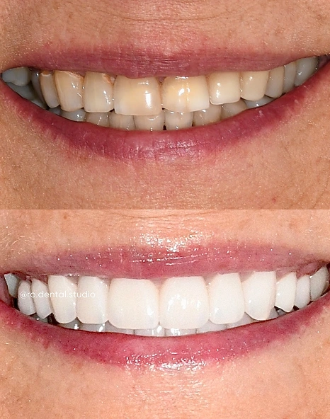 Before-and-after of a smile showing yellowed, slightly uneven teeth transformed into bright, evenly aligned teeth.
