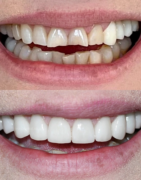 Before-and-after of a smile with chipped and misaligned front teeth corrected to a straight, white, and even smile.