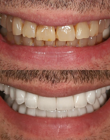 Before-and-after of a smile with discolored and slightly crooked teeth improved to a uniform, white, and straight smile.