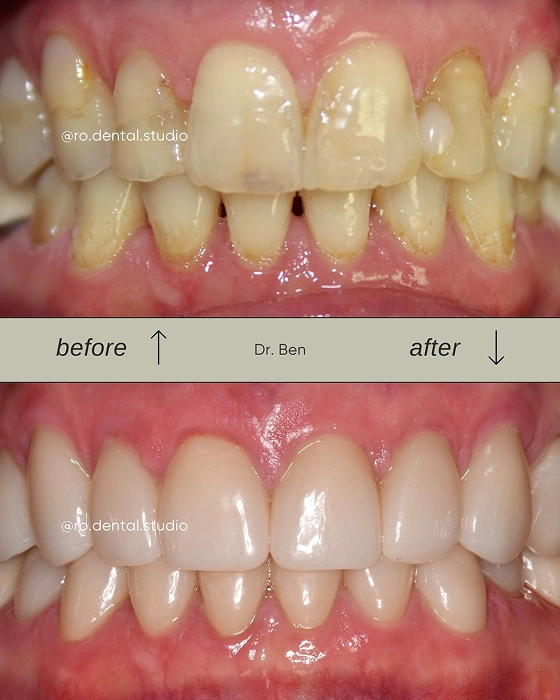 Teeth Restoration Before and After