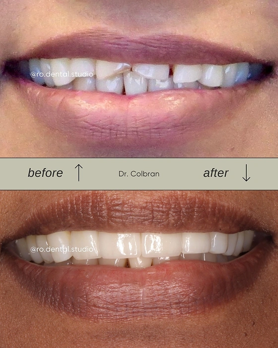 Teeth Whitening Before and After