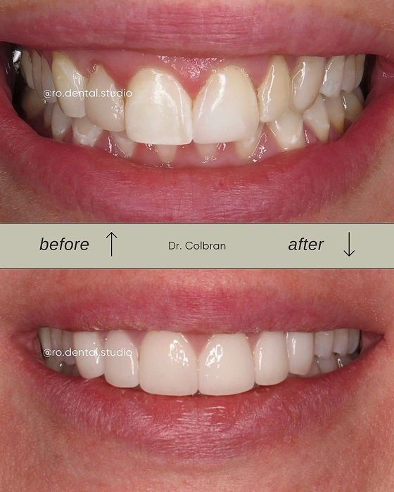 Veneers Before and After Natural Smile