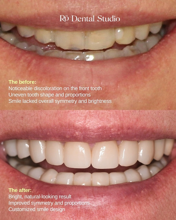 Before-and-after smile makeover correcting tooth discoloration, symmetry, and shape, resulting in a brighter, balanced, and natural-looking smile tailored to the patient.